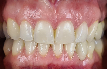 QDG Teeth Whitening 2024 After1