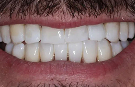 QDG Teeth Whitening 2024 After2