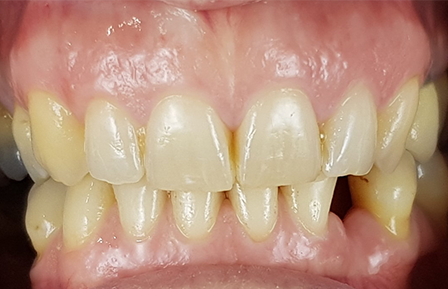 QDG Teeth Whitening 2024 Before1