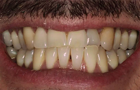 QDG Teeth Whitening 2024 Before2